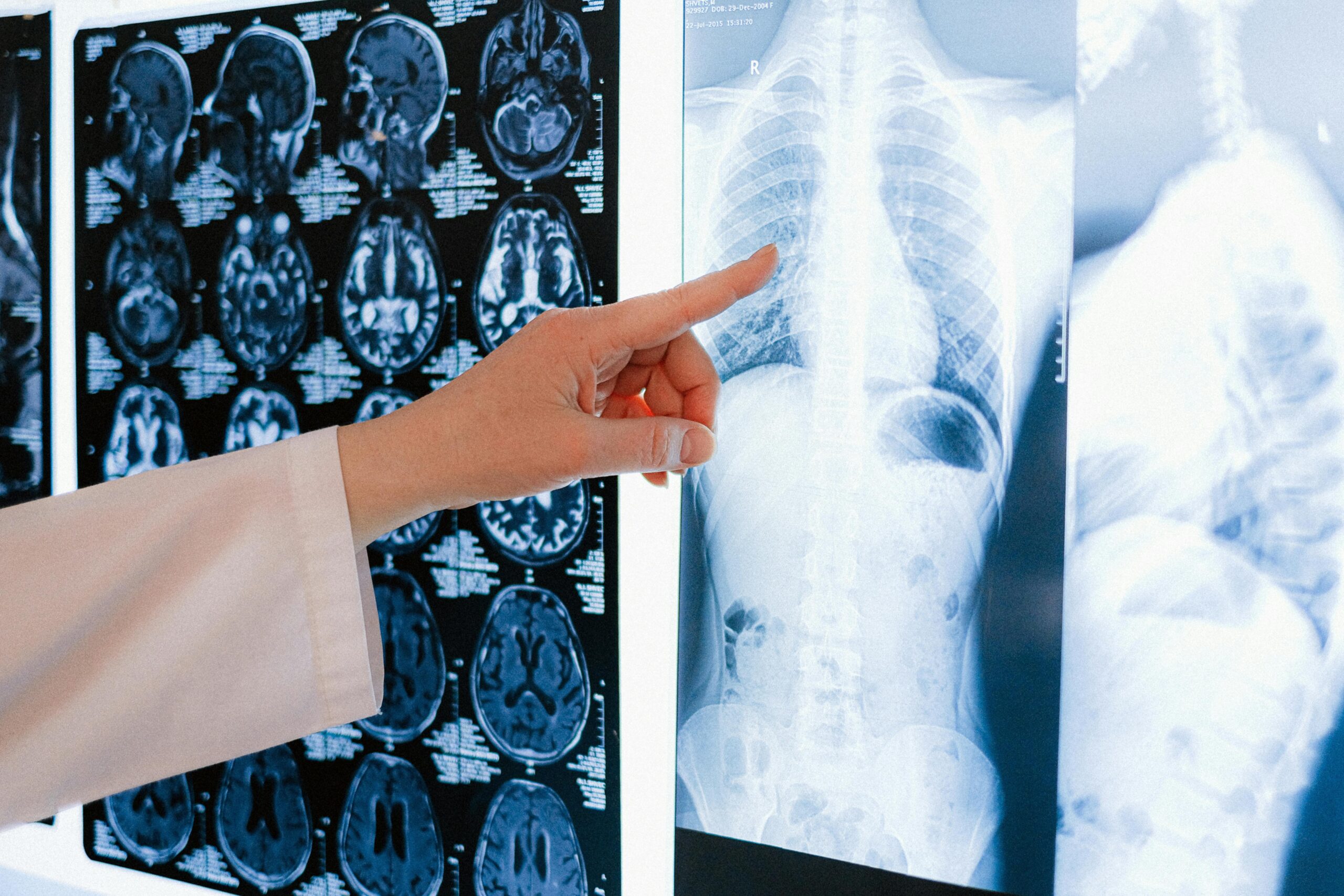 A medical professional checking for osteoporosis in an X-ray